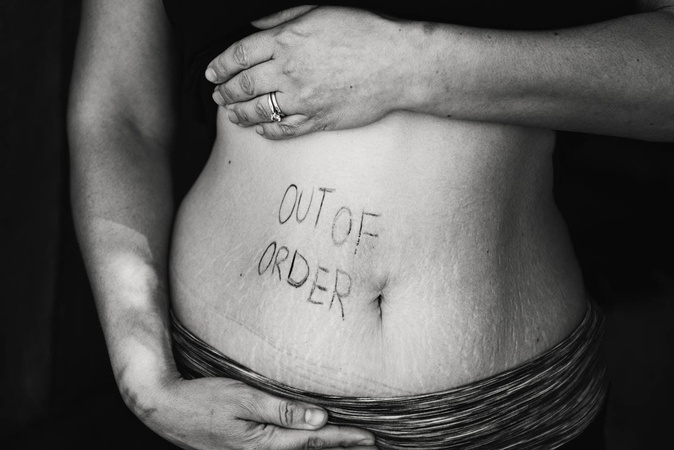 Zwillingsratgeber schwangerschaftsstreife-schwangerschaft-body-shaming Jetzt reicht’s! – Schluss mit Body-Shaming während der Schwangerschaft und nach der Geburt 